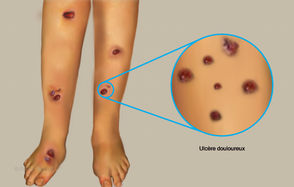 PYODERMA GANGRENOSUM